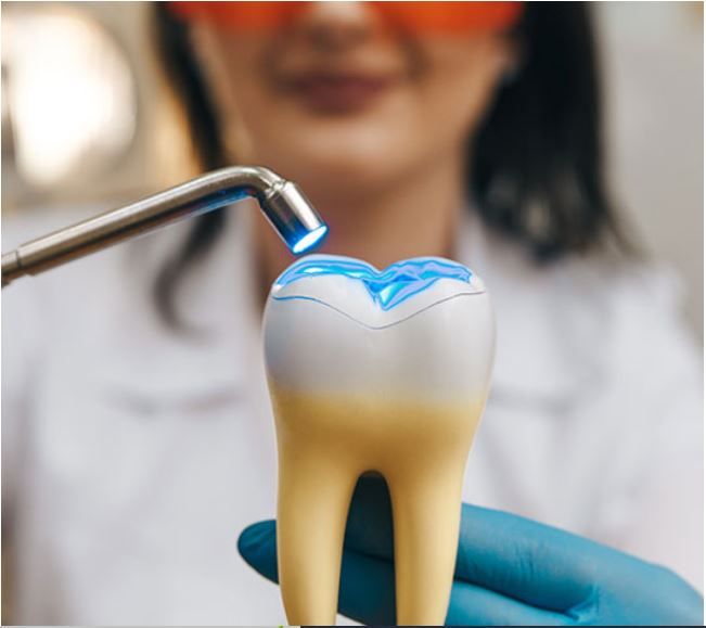 tooth coloured composite filling